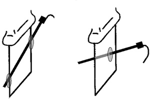 Figura 2. Abordajes fuera de plano (izquierda) y dentro de plano (derecha).
