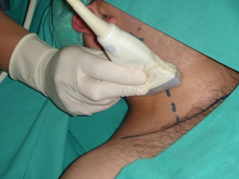 ¿Cómo realizar anestesia regional en cirugía ambulatoria de hombro?