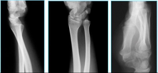 Another clinical case of distal radius ulnar joint instability