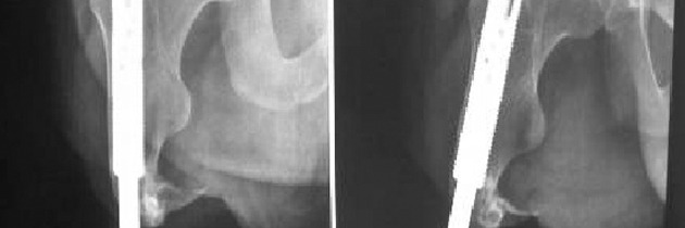 Osteointegración en pacientes amputados