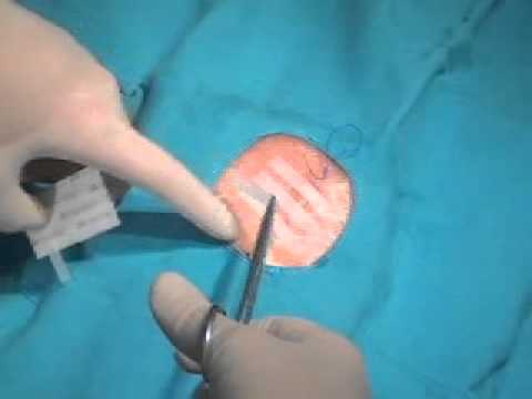 Cobertura sutura subdérmica