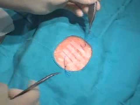 Técnicas enfermería: retirada sutura subdérmica