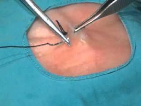 Técnicas enfermería: sutura punto doble