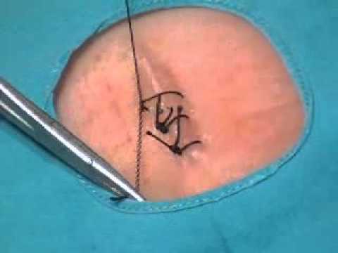 Técnicas enfermería: sutura punto simple