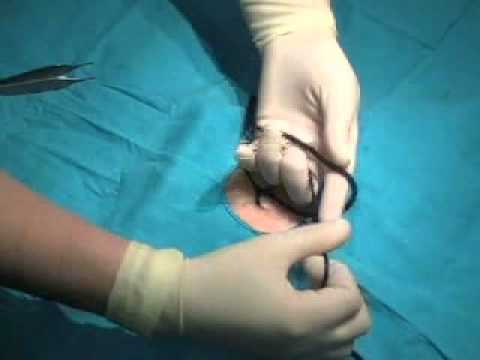 Técnicas de sutura: Anudado a mano