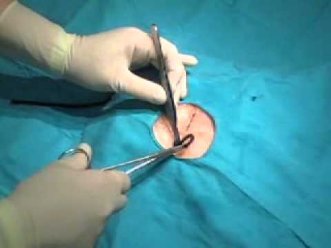 Ténicas enfermería: Fin sutura contínua